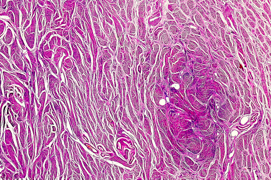 Human cervical ectropion, light micrograph