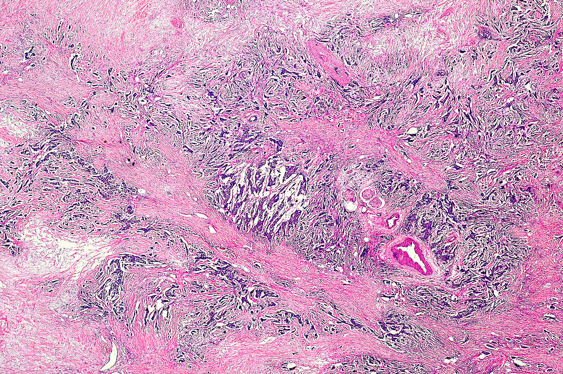 Invasive ductal carcinoma of the breast, light micrograph