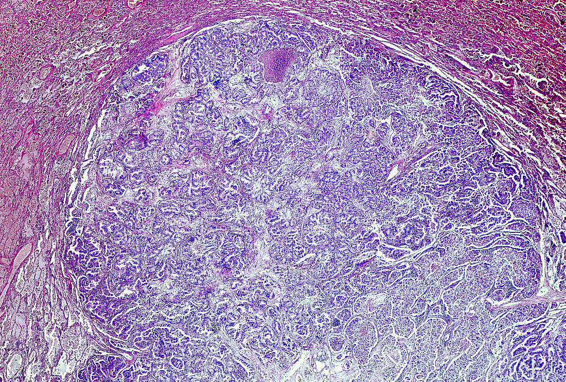 Human lung adenocarcinoma, light micrograph