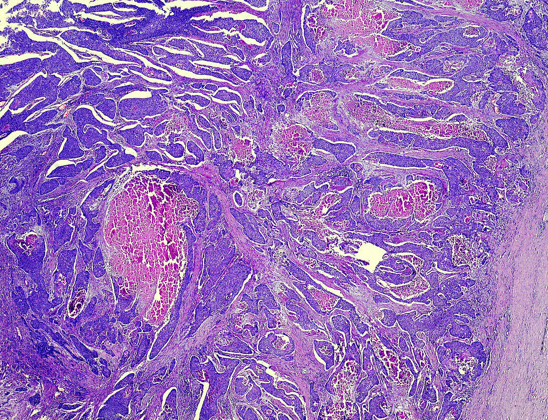Oesophageal squamous cell carcinoma, light micrograph
