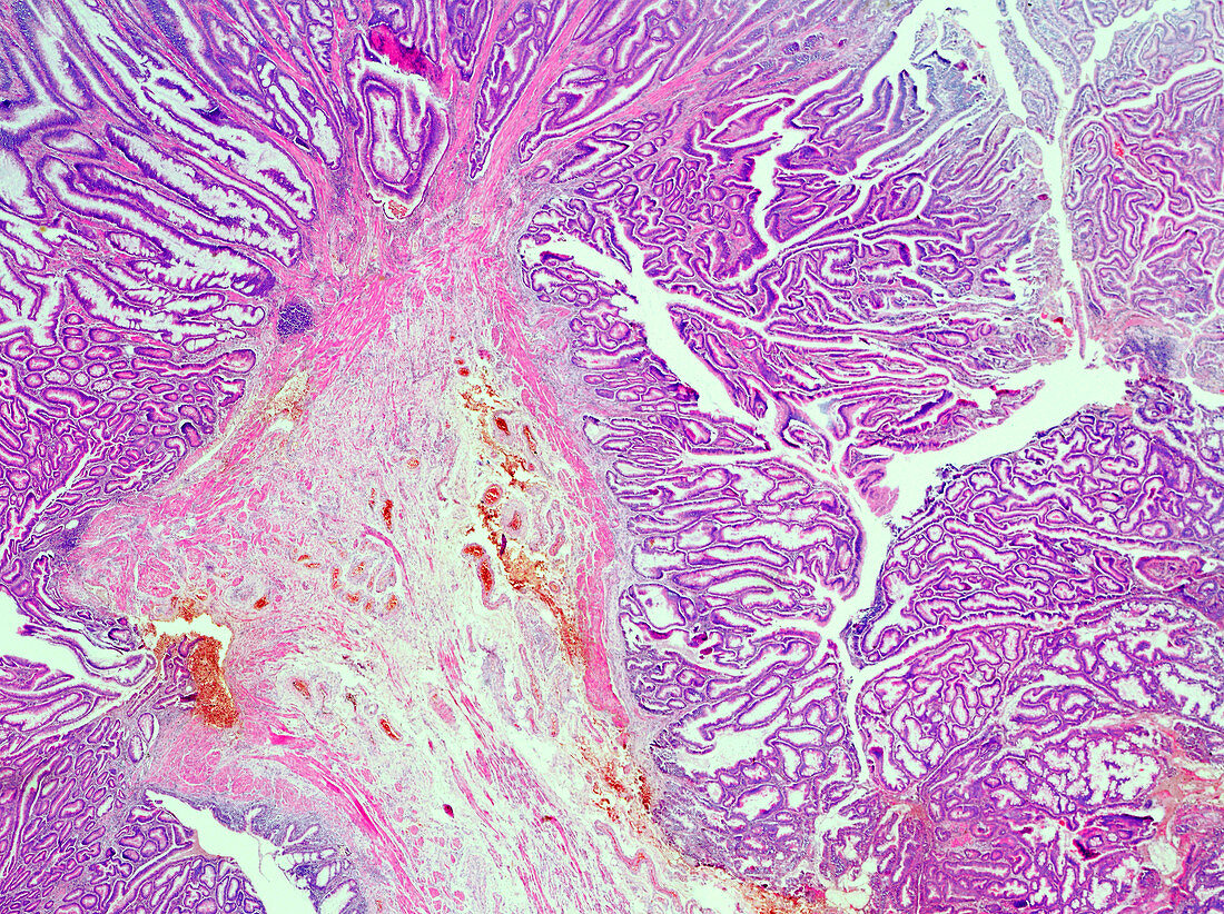 Adenomatous papilloma of the human rectum, light micrograph