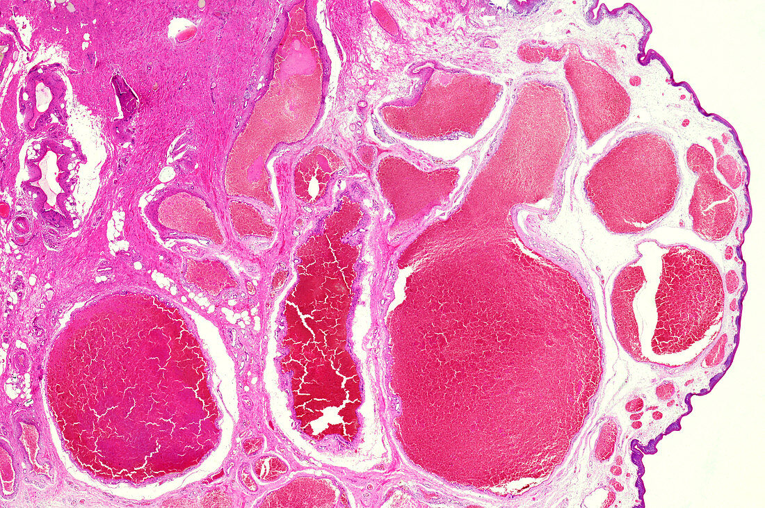 Thrombus blocking lumen in veins, light micrograph