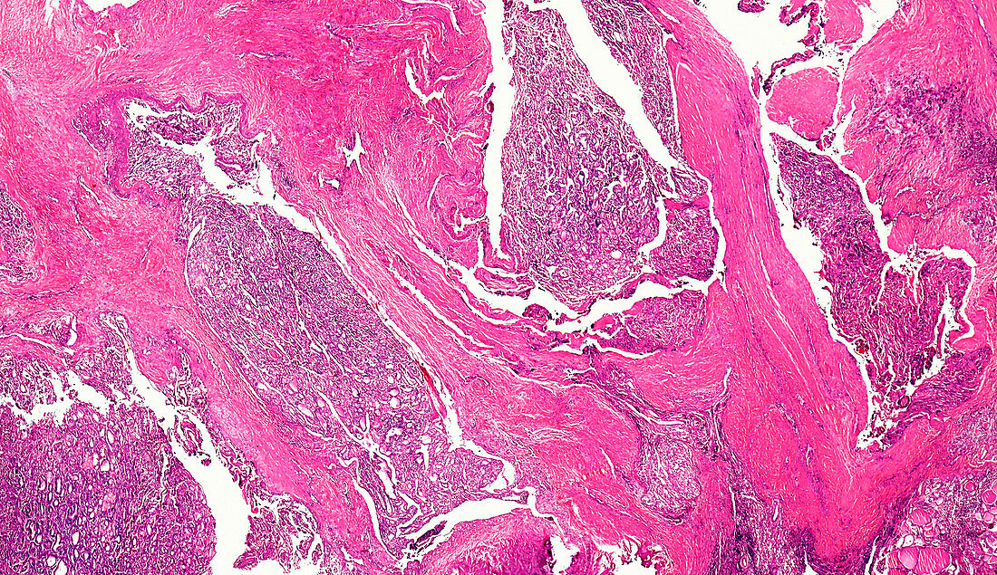 Human follicular thyroid carcinoma, light micrograph