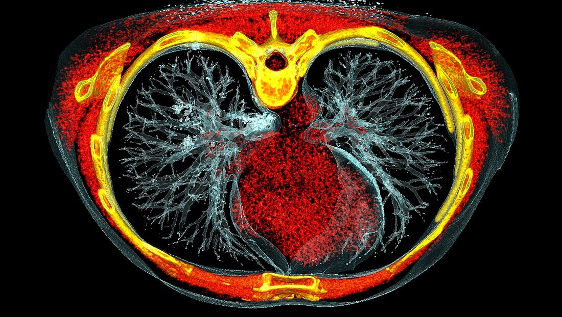 Lungs affected by Covid-19 pneumonia, CT scan