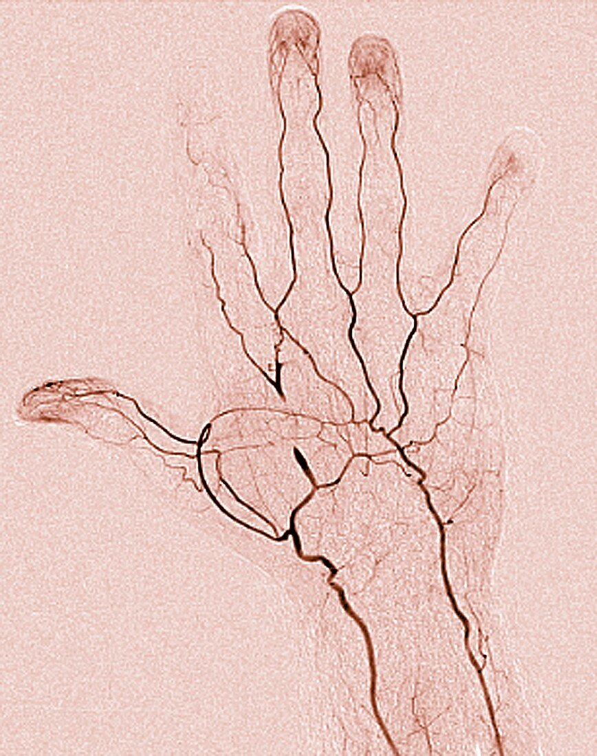 Blocked hand artery, angiogram