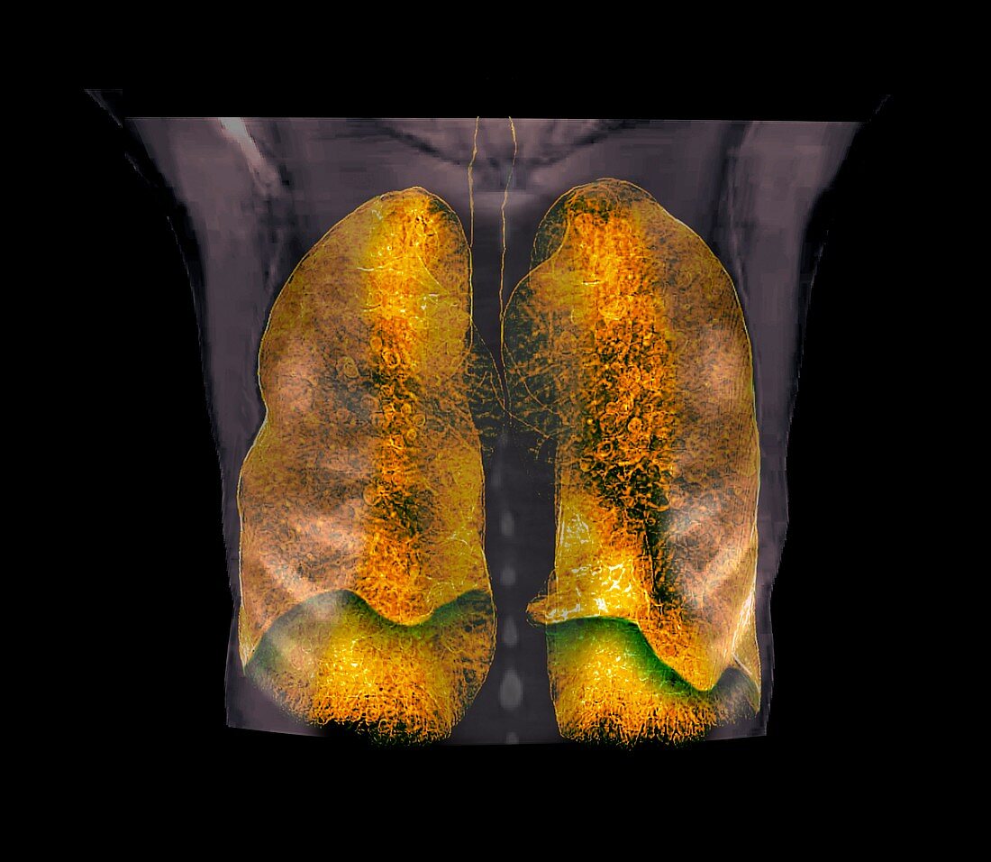 Emphysema, CT scan