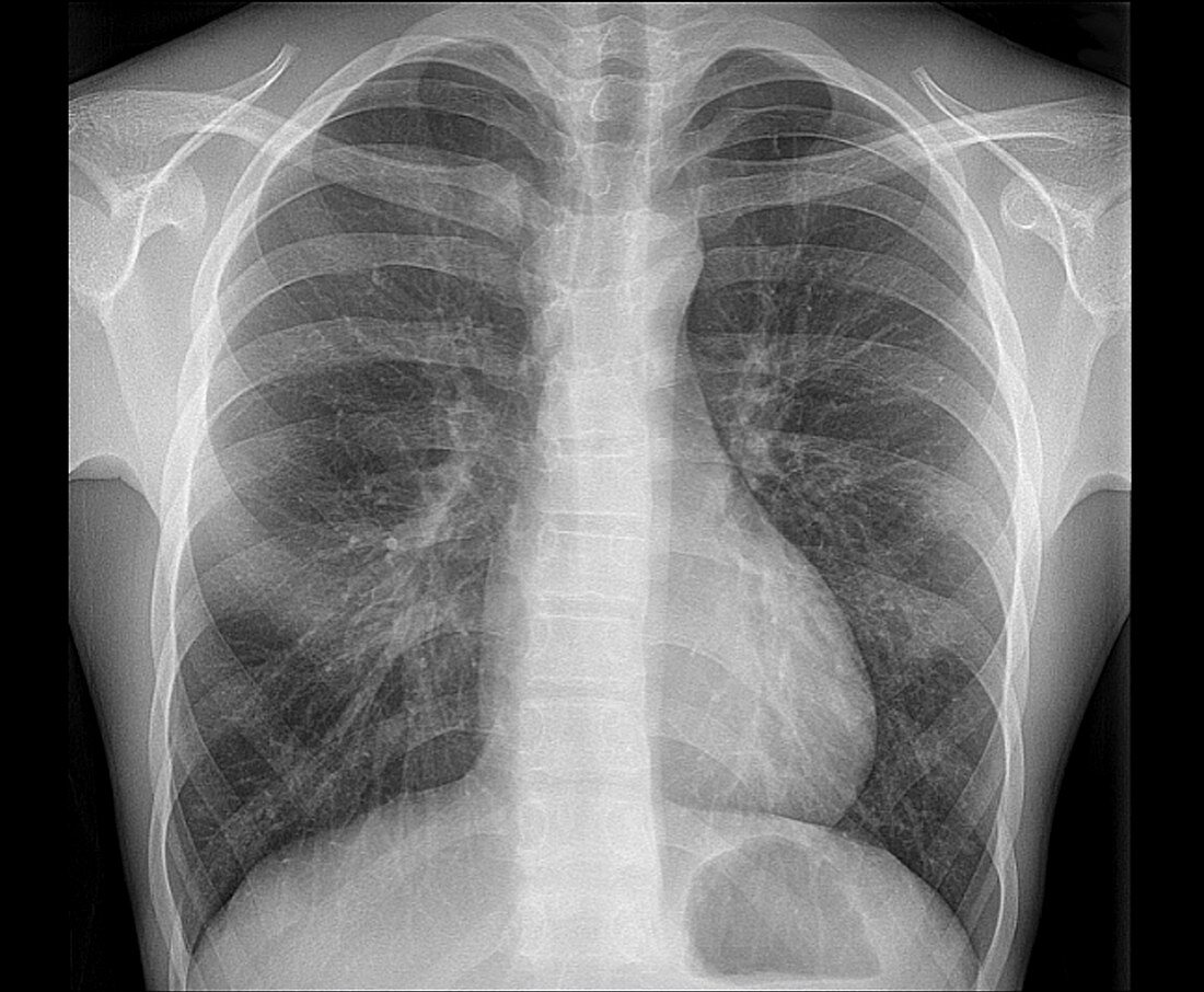 Healthy lungs, X-ray