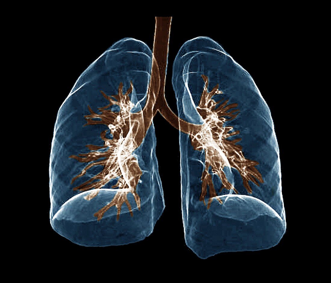 Healthy lungs, CT scan