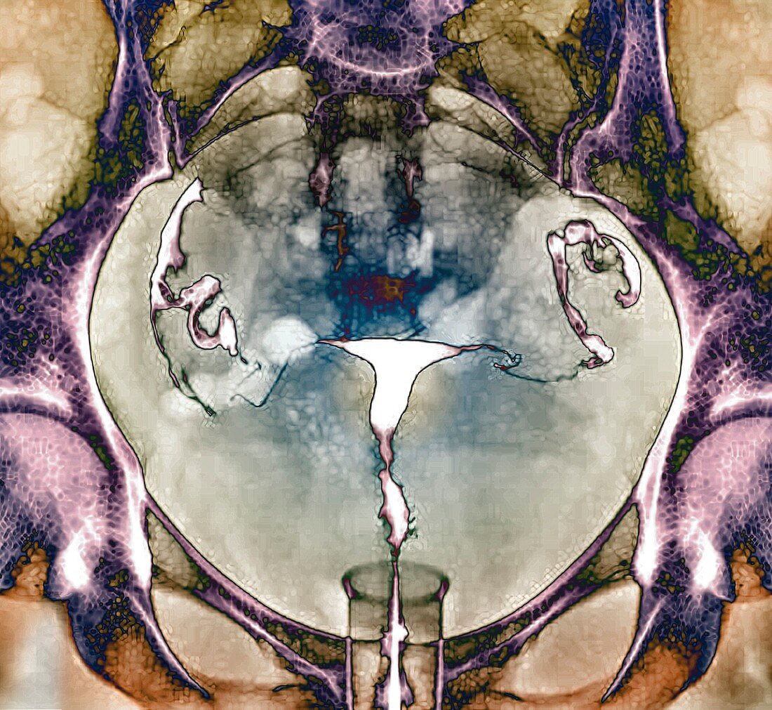 Healthy female reproductive system, X-ray