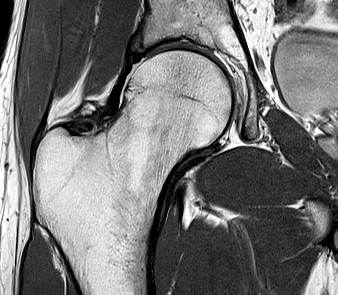 Healthy hip joint, MRI scan