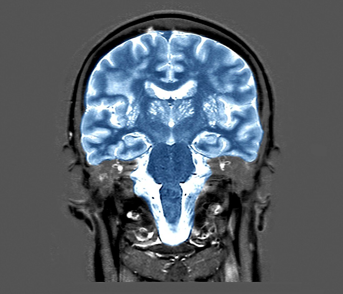 Cerebral atrophy, MRI scan