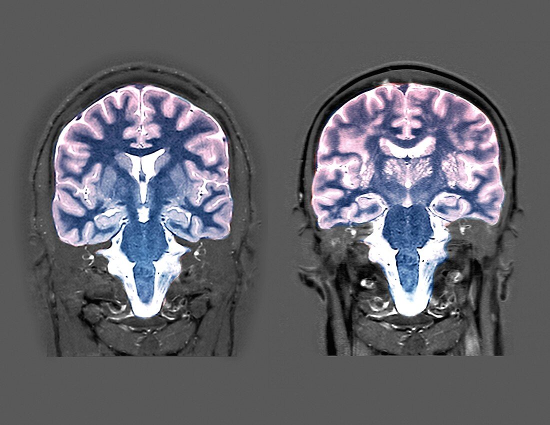 Young and old brians, MRI scans
