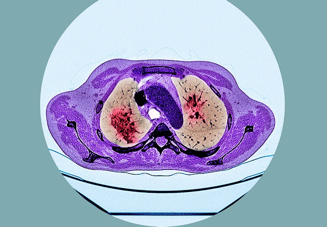 Lungs affected by Covid-19 pneumonia, CT scan