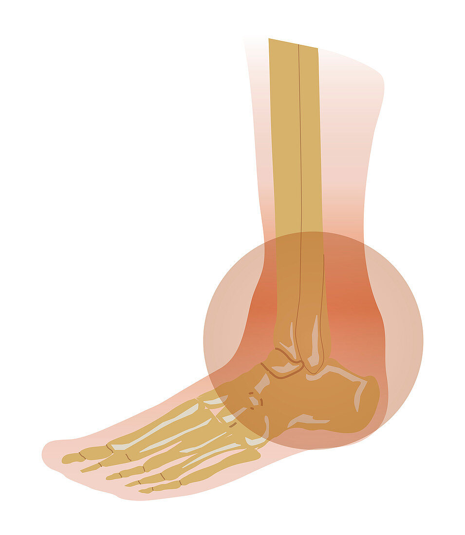 Inflamed ankle joint, illustration