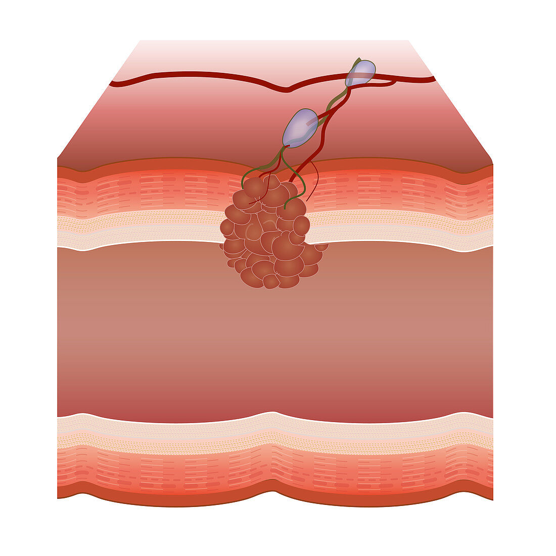 Tumour, illustration