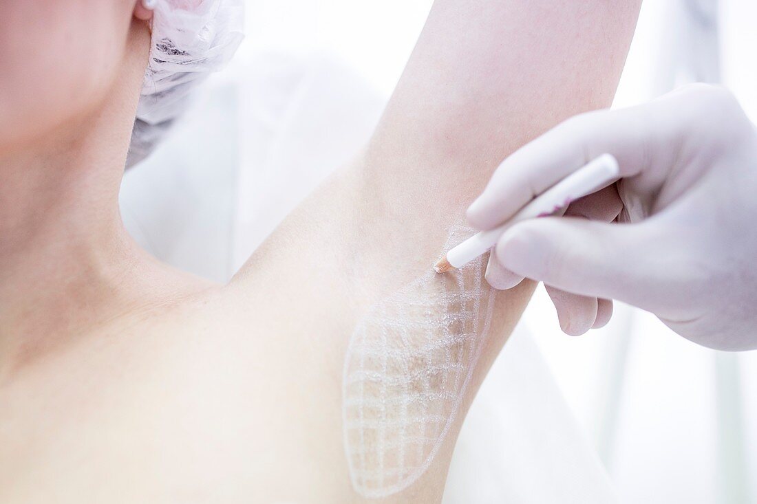 Dermatologist marking on woman's underarm