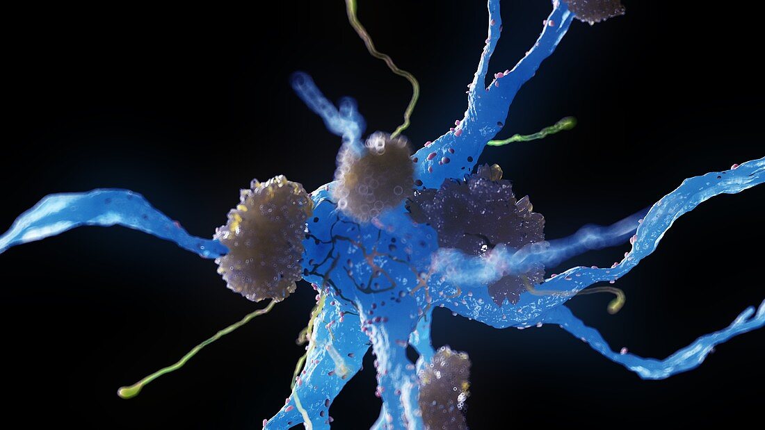 Alzheimer's nerve cells, illustration