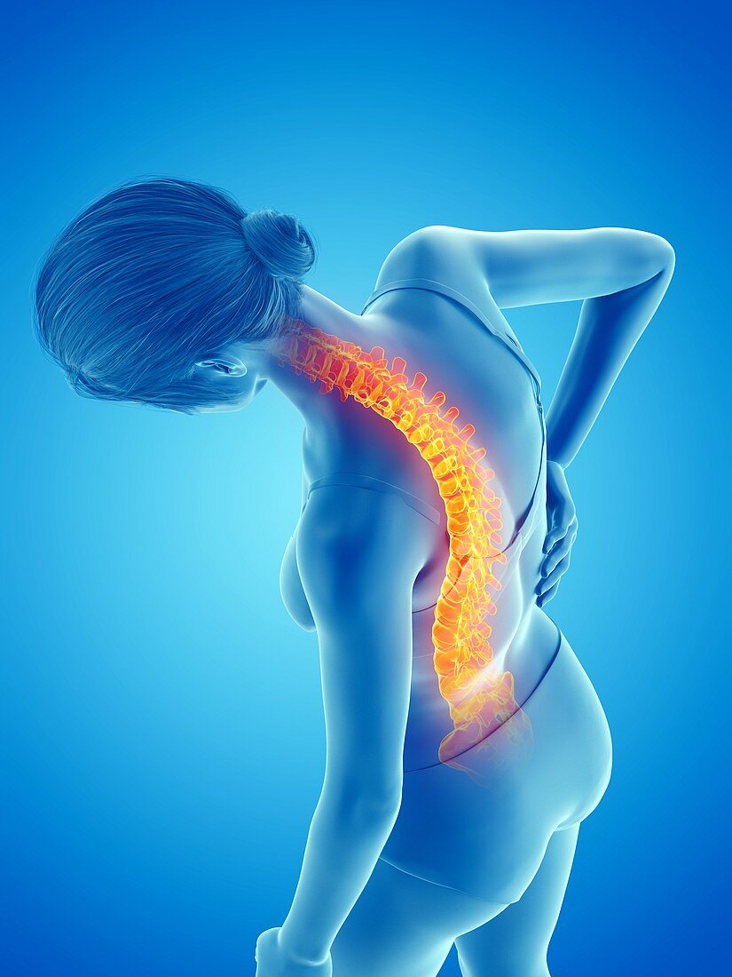 Woman with a painful back, illustration