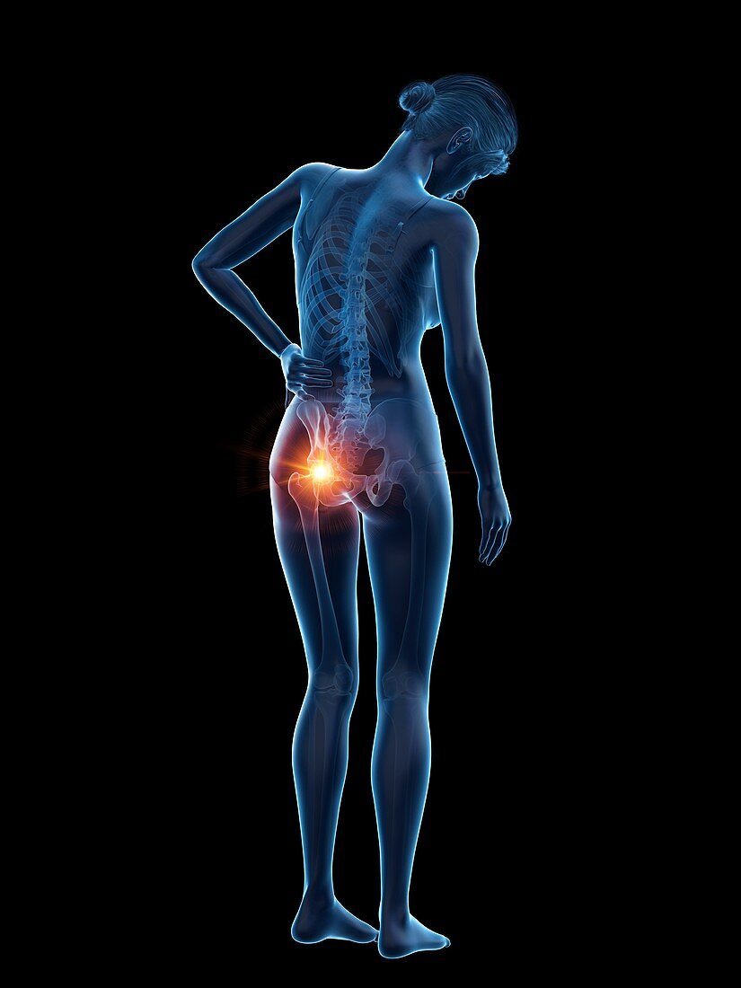 Woman with a painful hip, illustration