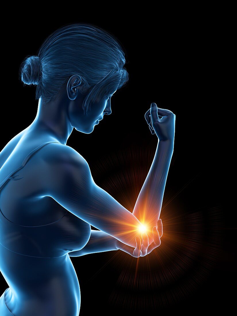 Woman with a painful elbow, illustration