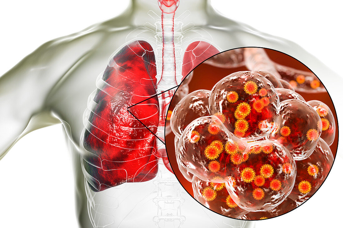 Coronavirus disease of the lungs, conceptual illustration