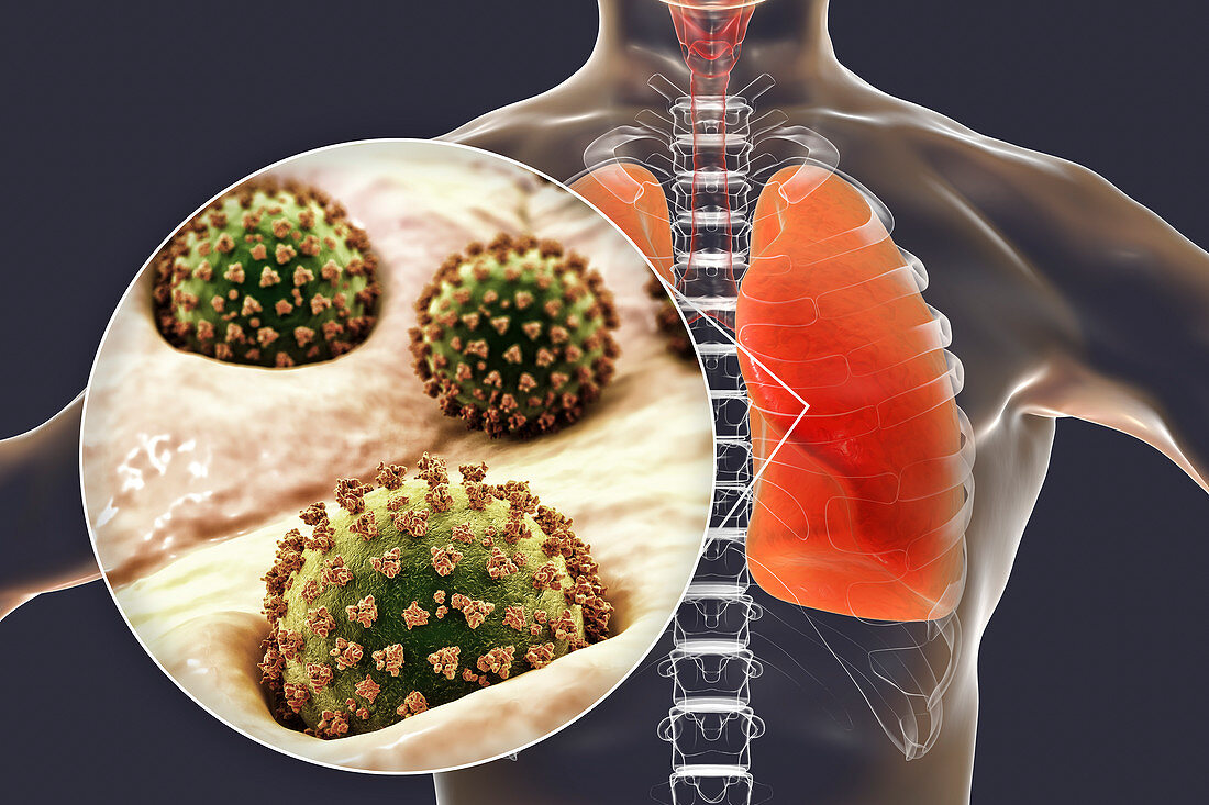 Coronavirus disease of the lungs, conceptual illustration