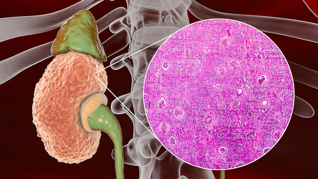 Chronic kidney disease, illustration and light micrograph