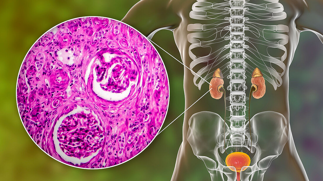Chronic kidney disease, illustration and light micrograph