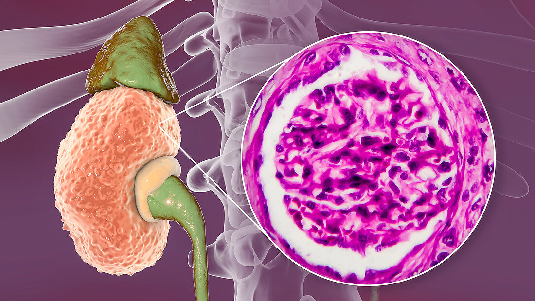 Chronic kidney disease, illustration and light micrograph