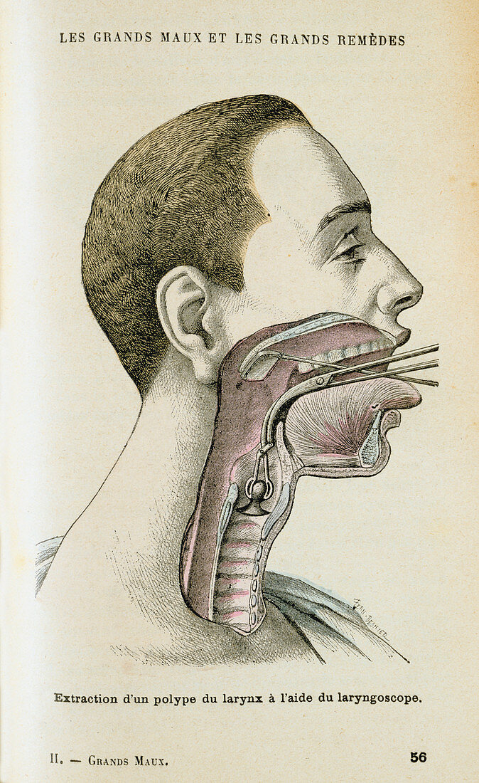 Removal of a polyp from the throat, c1890