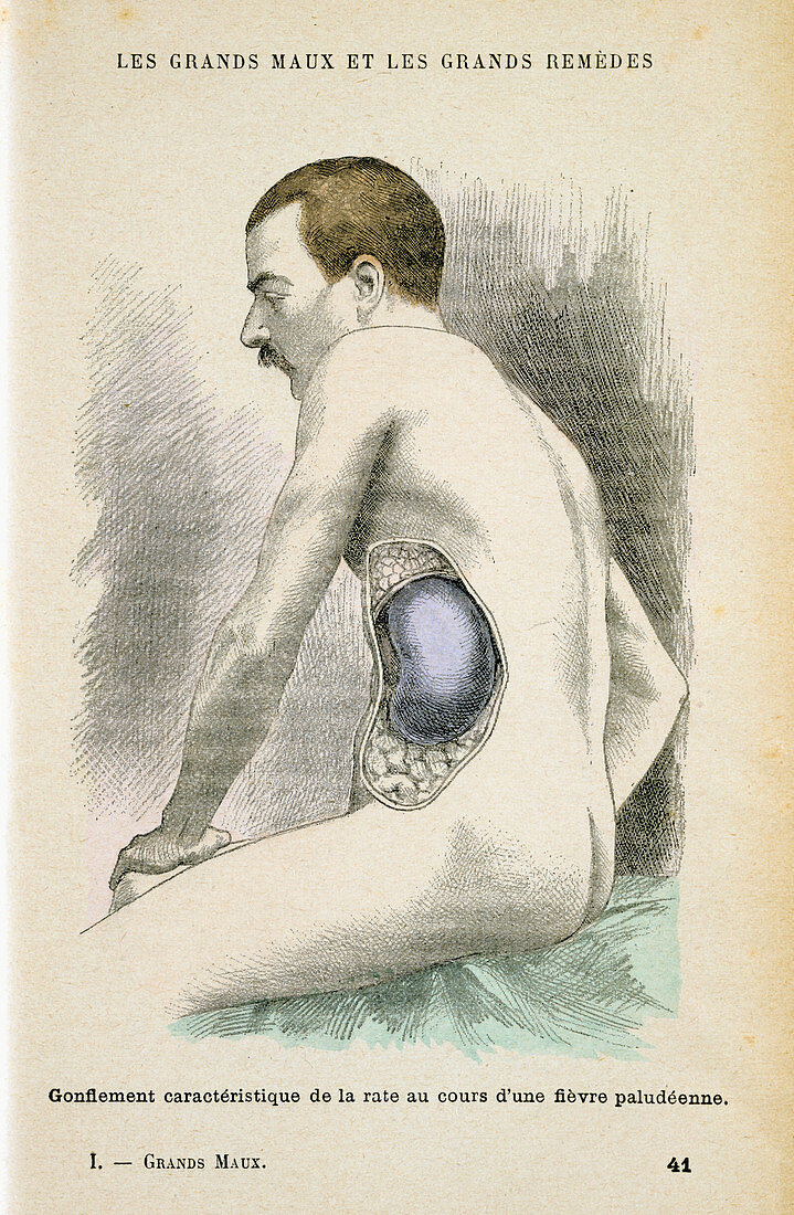 Typical enlarged spleen of a Malaria patient, c1890