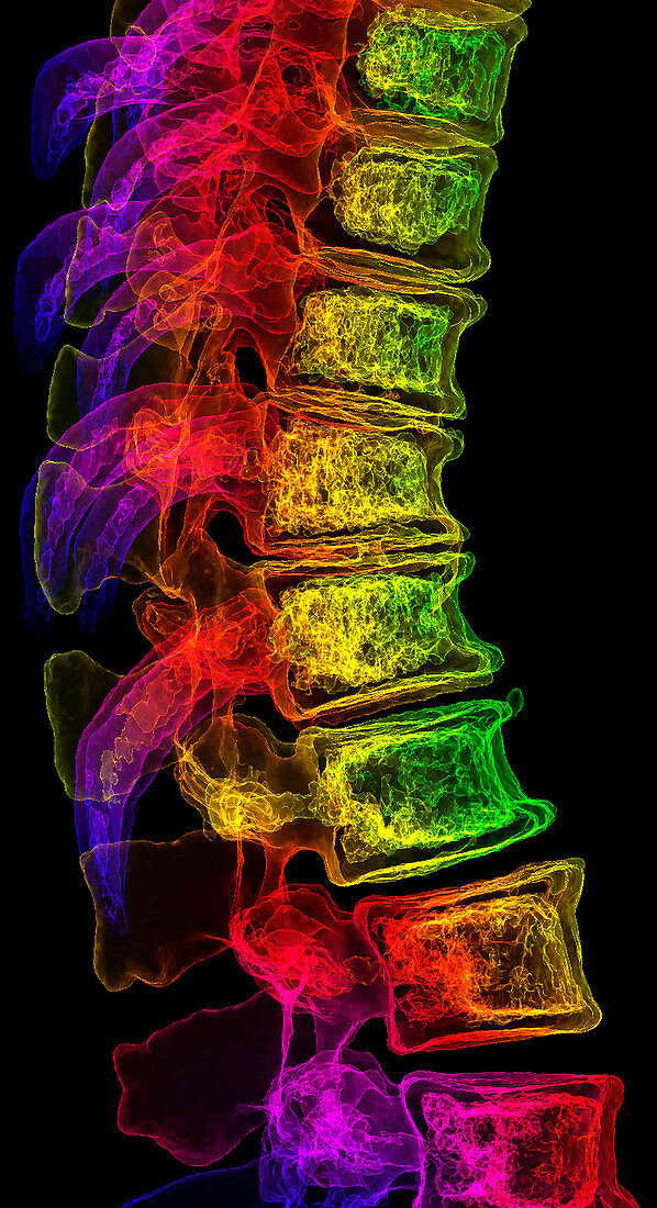 Spinal osteoporosis, 3D CT scan