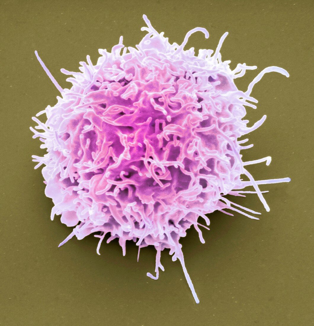 Lymphoma cancer cell.