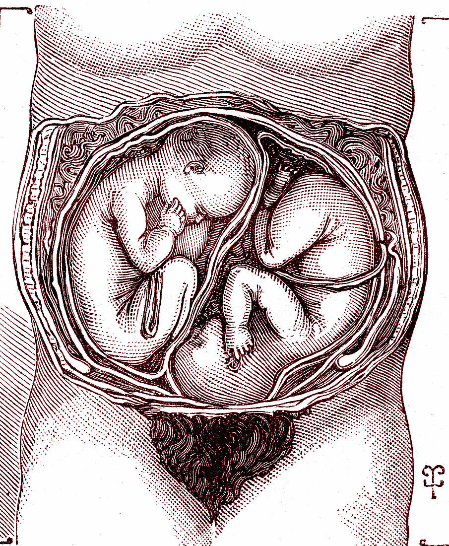 Twin pregnancy, 19th century