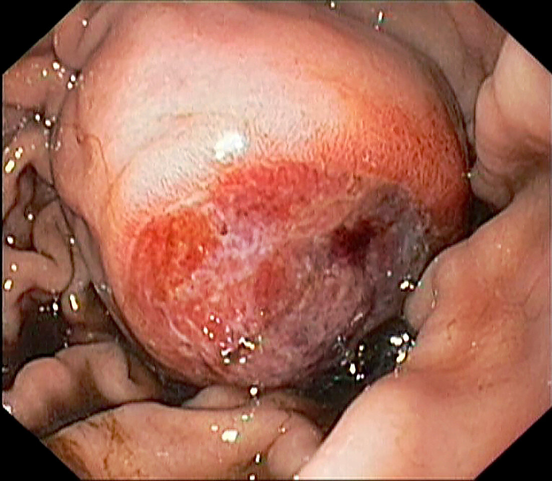 Gastrointestinal stromal tumour, endoscopic image