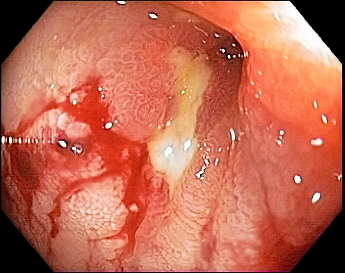 Small intestine in Crohn's disease, endoscopic image