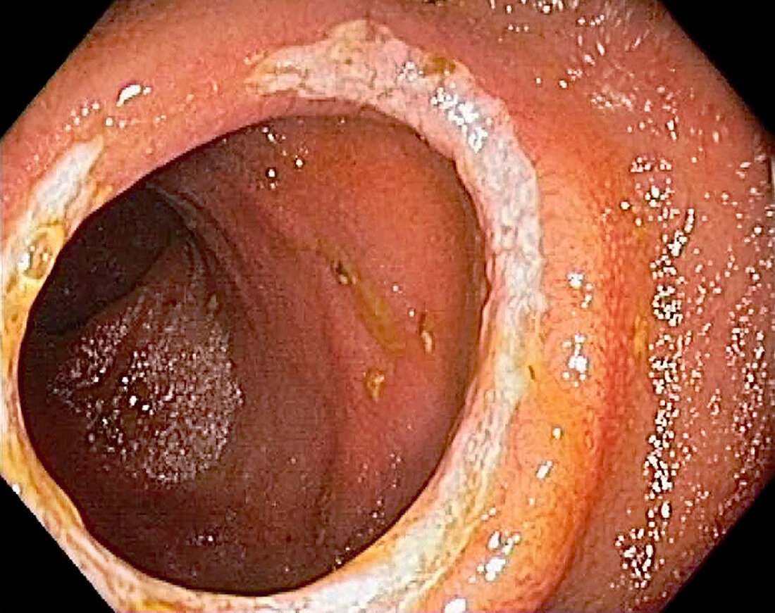 Small intestine in Crohn's disease, endoscopic image