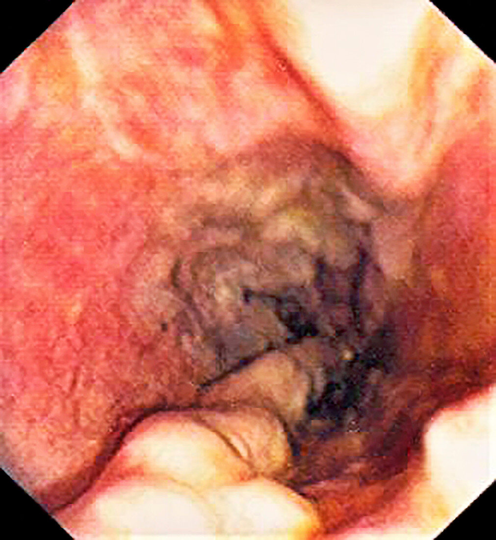 Oesophageal varices in Banti's syndrome, endoscopic image