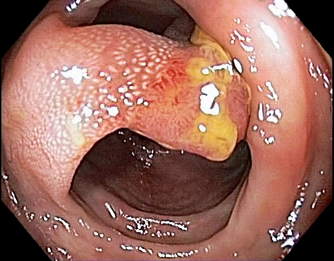 Tubular adenoma, colonoscopy image