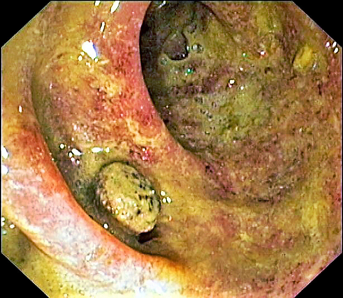 Large intestine in ulcerative colitis, colonoscopy image