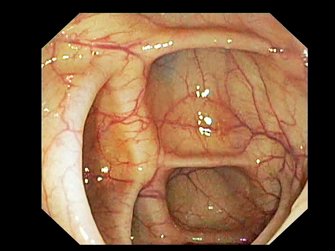 Angiodysplasia of the caecum, endoscopic image