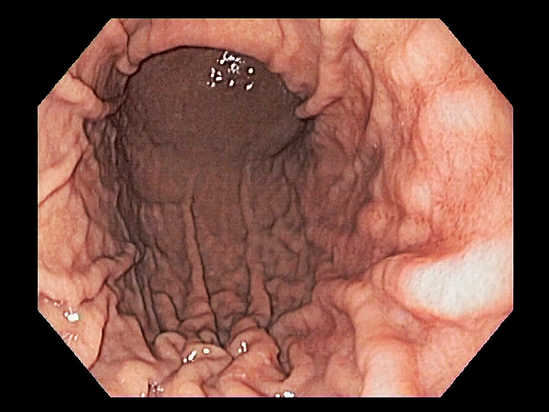 Normal stomach, endoscopic image