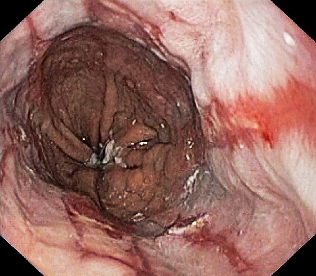 Oesophagitis, endoscopic image