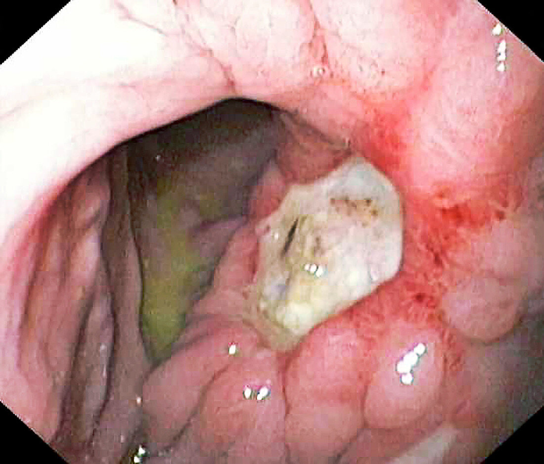 Stomach cancer, endoscopic image