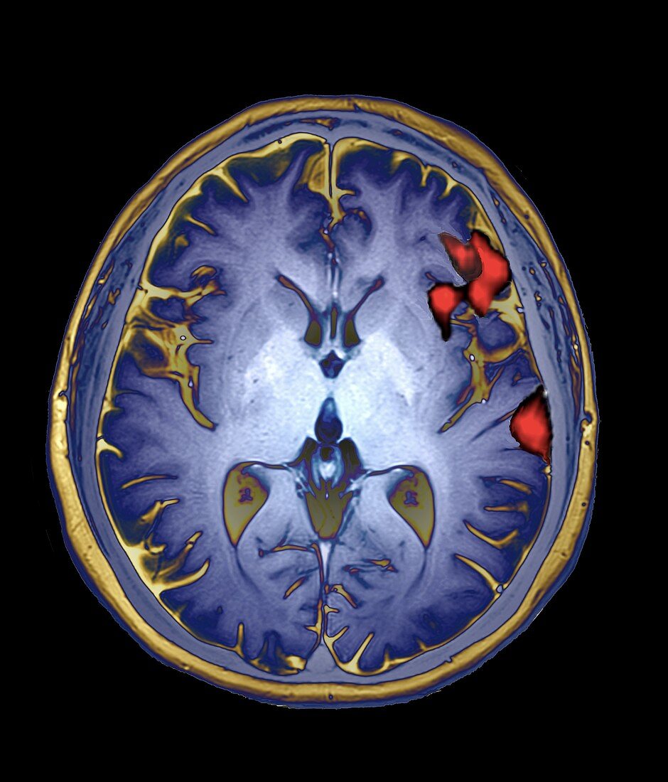 Brain activity in speech production, MRI