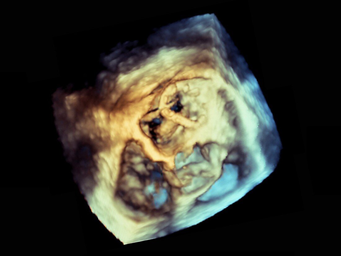 Heart in cardiac fibrosis, ultrasound