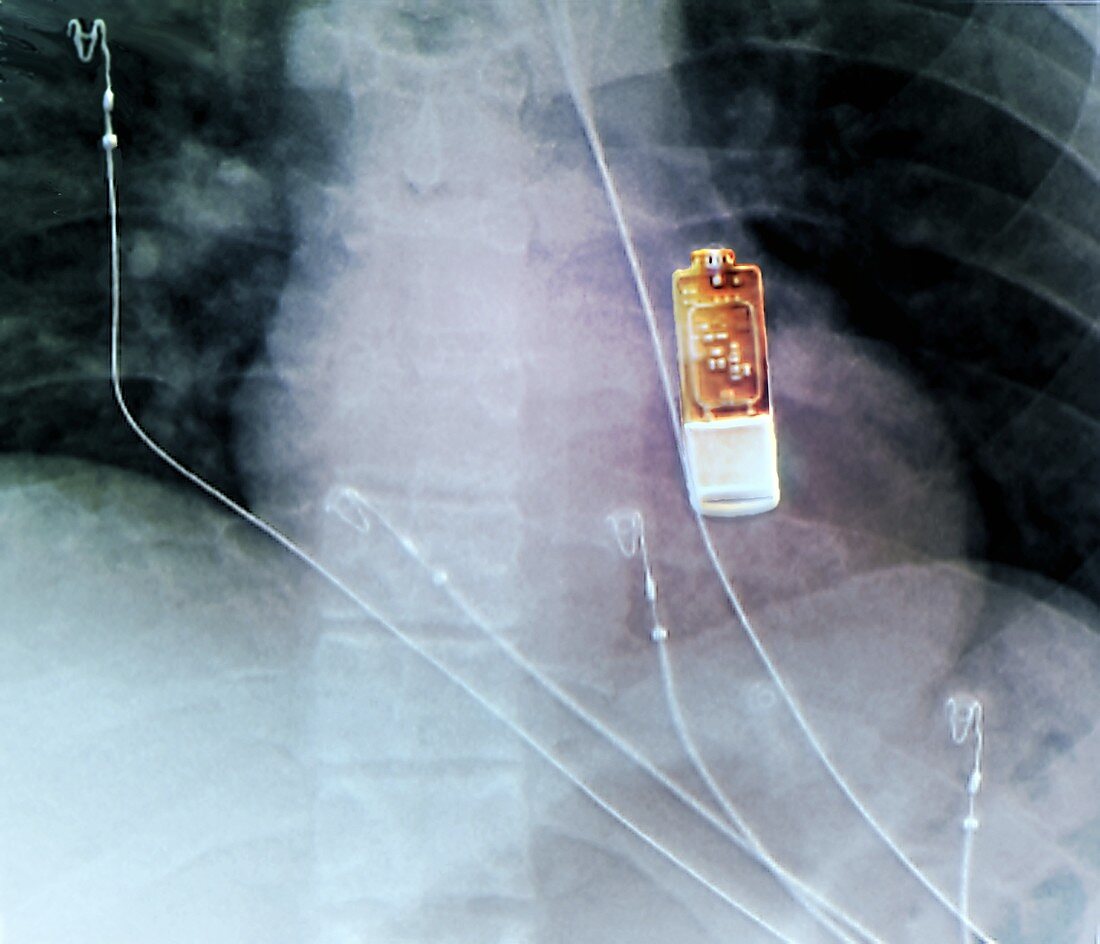 Cardiac monitor implant, X-ray