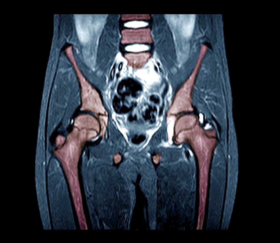 Hip inflammation, MRI