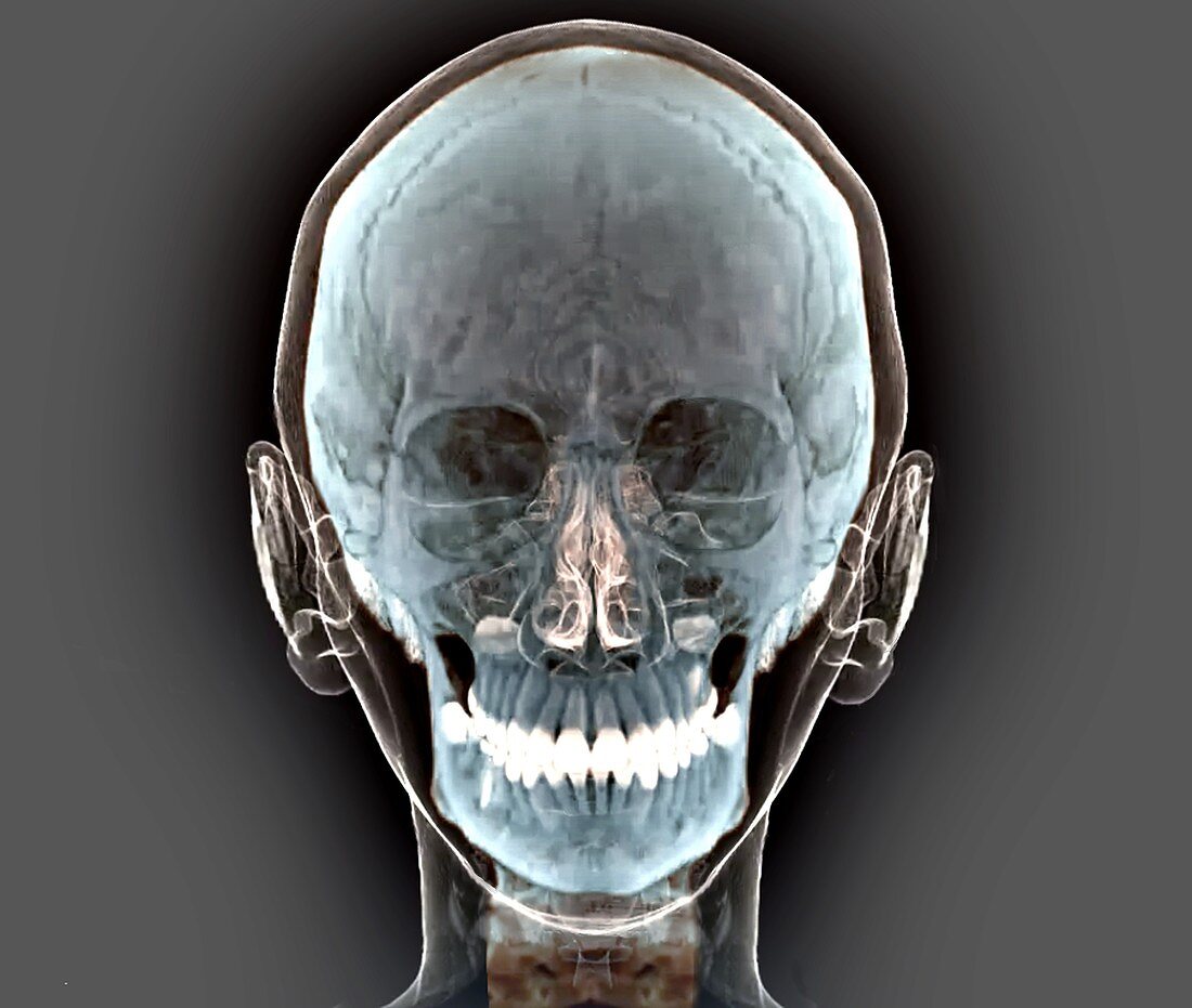 Normal human skull, 3D CT scan
