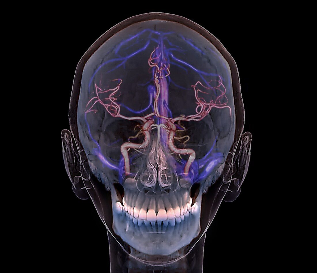 Normal brain blood supply, 3D CT scan